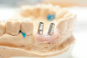 Was Zahnimplantate kosten Was Zahnimplantate kosten