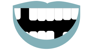 Teilprothese Teilprothese