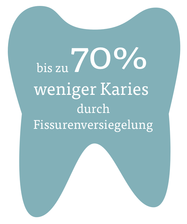 Bis zu 70% weniger Karies durch Fissurenversiegelung